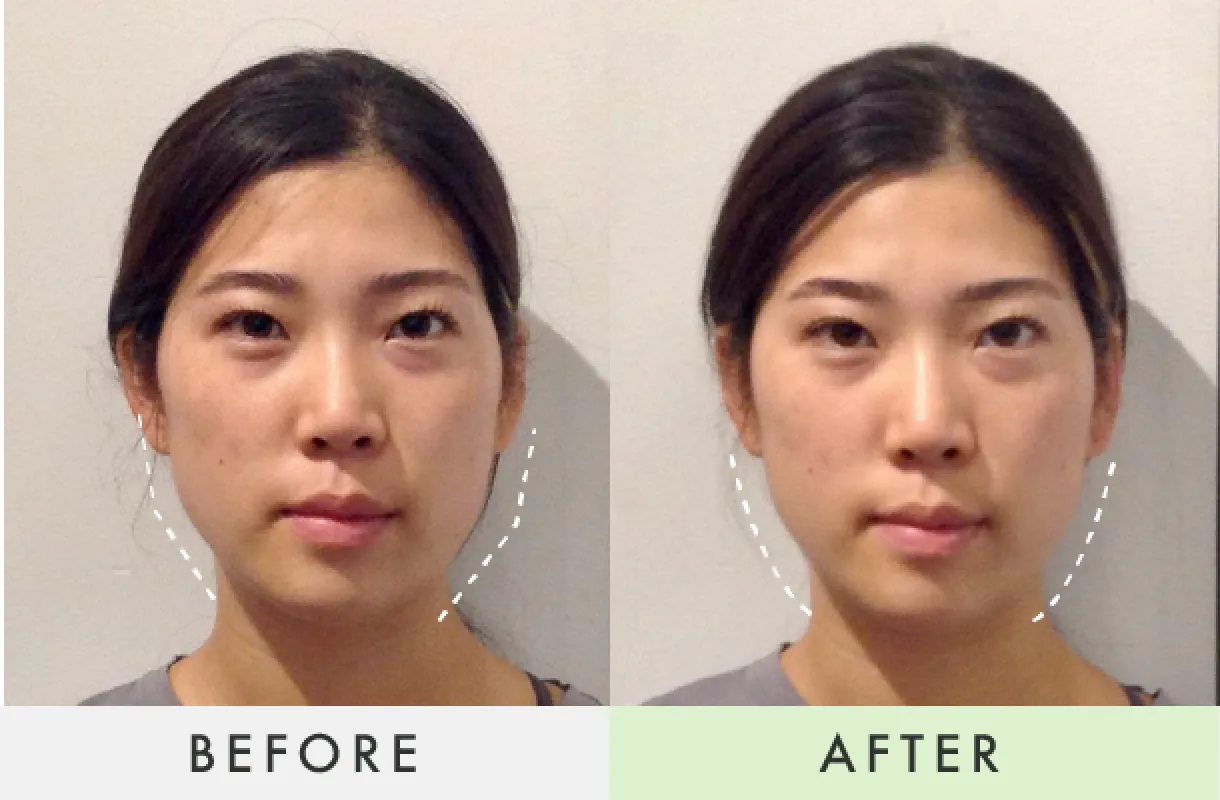 Before-After