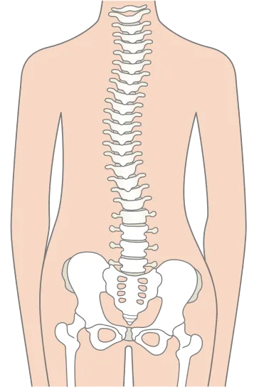 側弯のある背骨