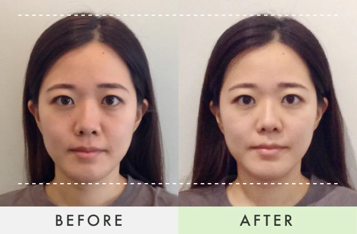 Before-After